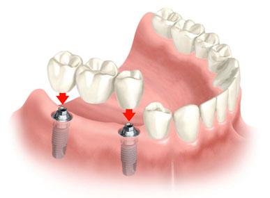 fogászati implantáció fogbeültetés, híd