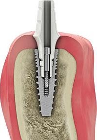 fogászati implantáció fogbeültetés, implantációs csavar